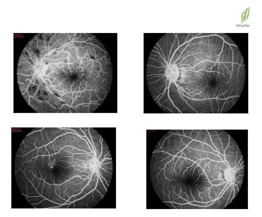 FFA FUNDUS PIC